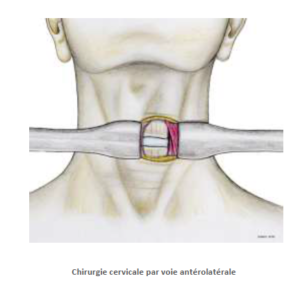 chirurgie cervicale par voie antérolatérale SFCR Denux