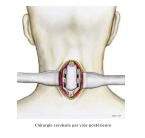 chirurgie cervicale par voie postérieure SFCR Denux